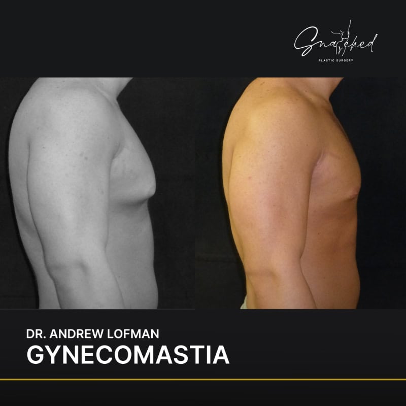 Gynecomastia surgery before and after comparison