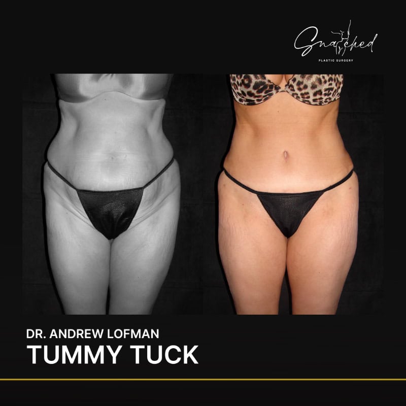 Before and after tummy tuck transformation photo.