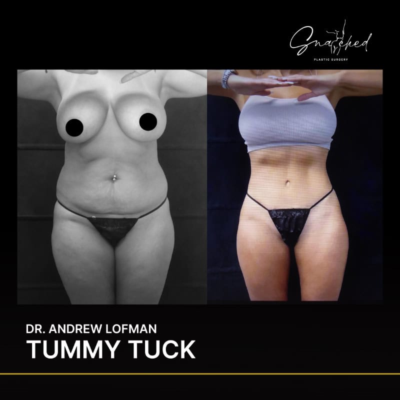 Tummy tuck before and after transformation results.