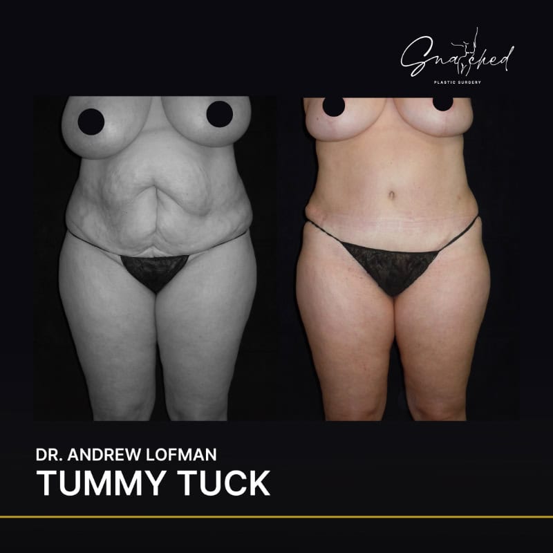 Before and after of tummy tuck procedure