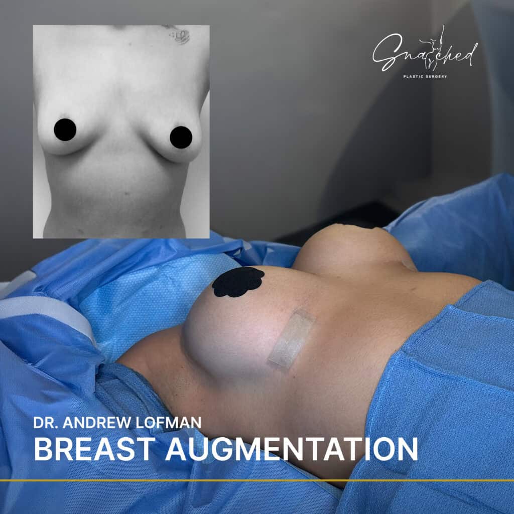 Breast augmentation procedure and results shown.
