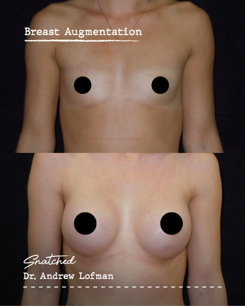 Before and after breast augmentation comparison.