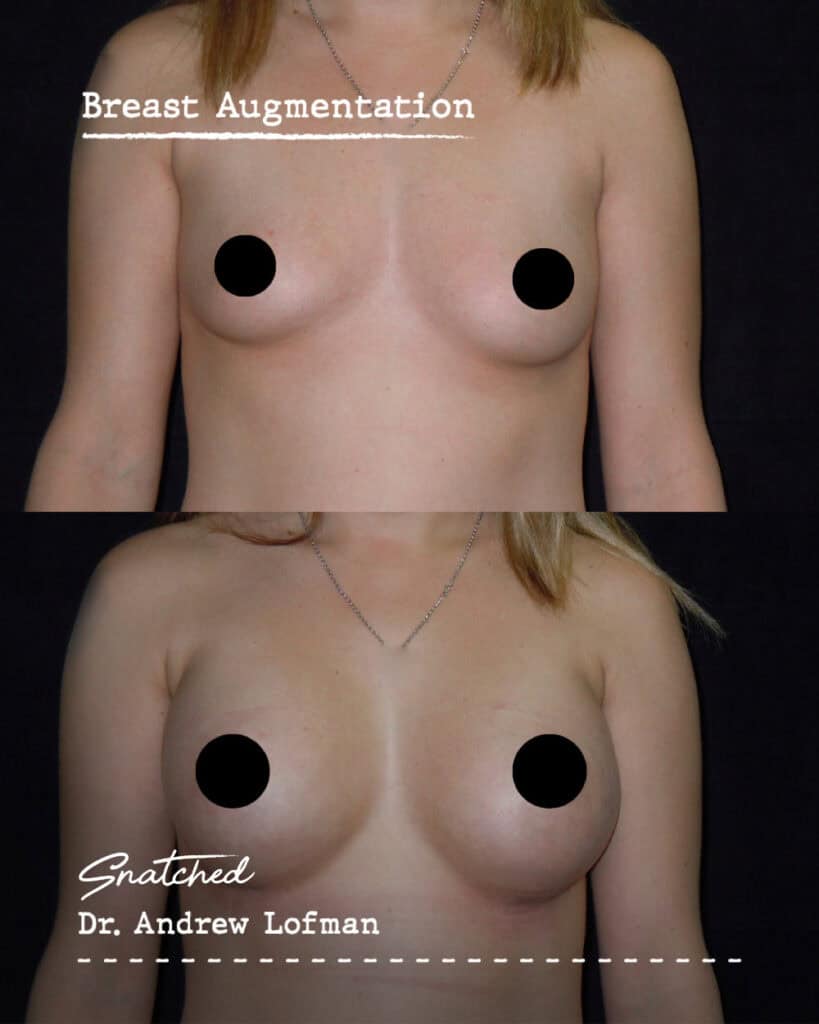 Before and after breast augmentation results