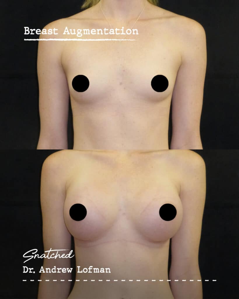 Before and after breast augmentation transformation.