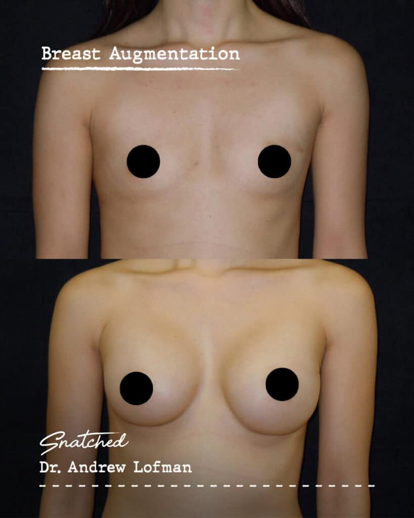 Before and after breast augmentation comparison