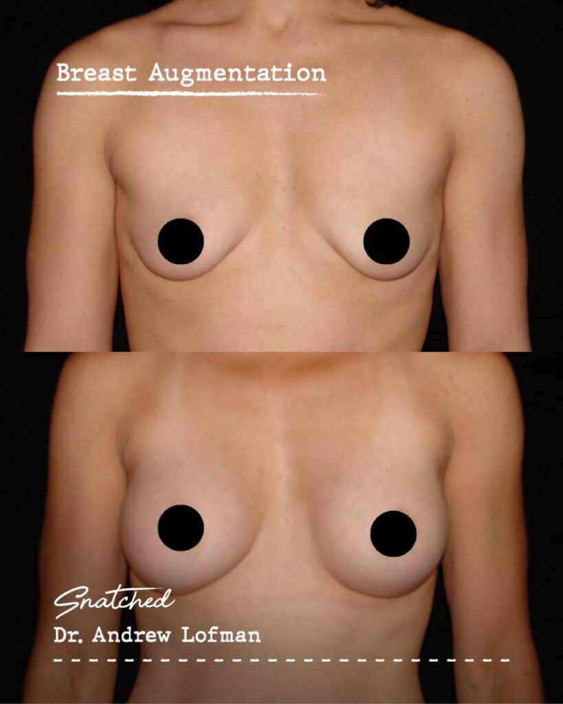 Breast augmentation before and after comparison.