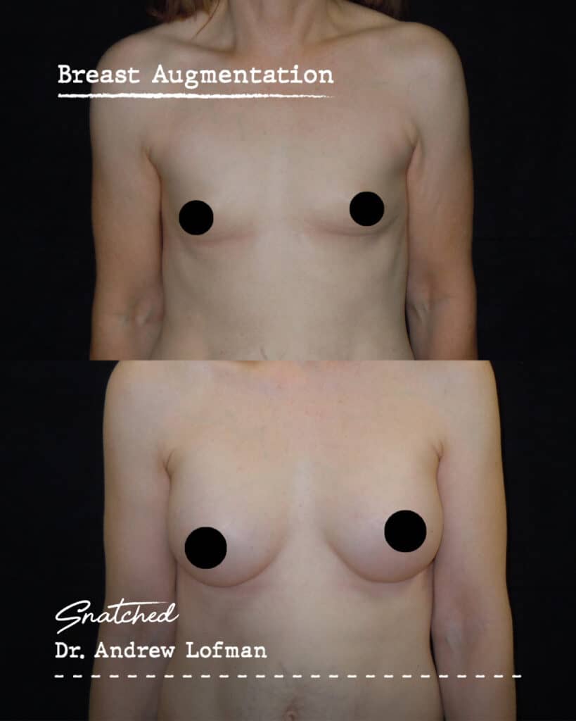 Before and after breast augmentation results.