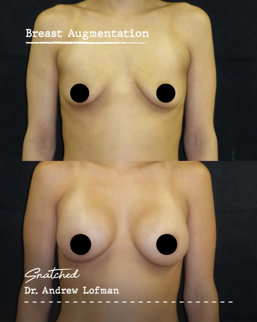Before and after breast augmentation results.