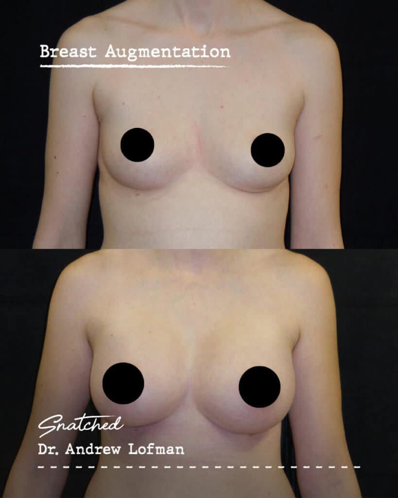 Before and after breast augmentation comparison.