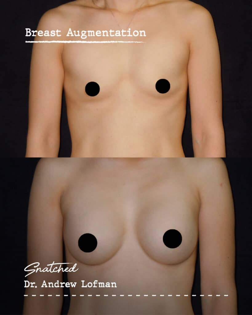 Before and after breast augmentation comparison.