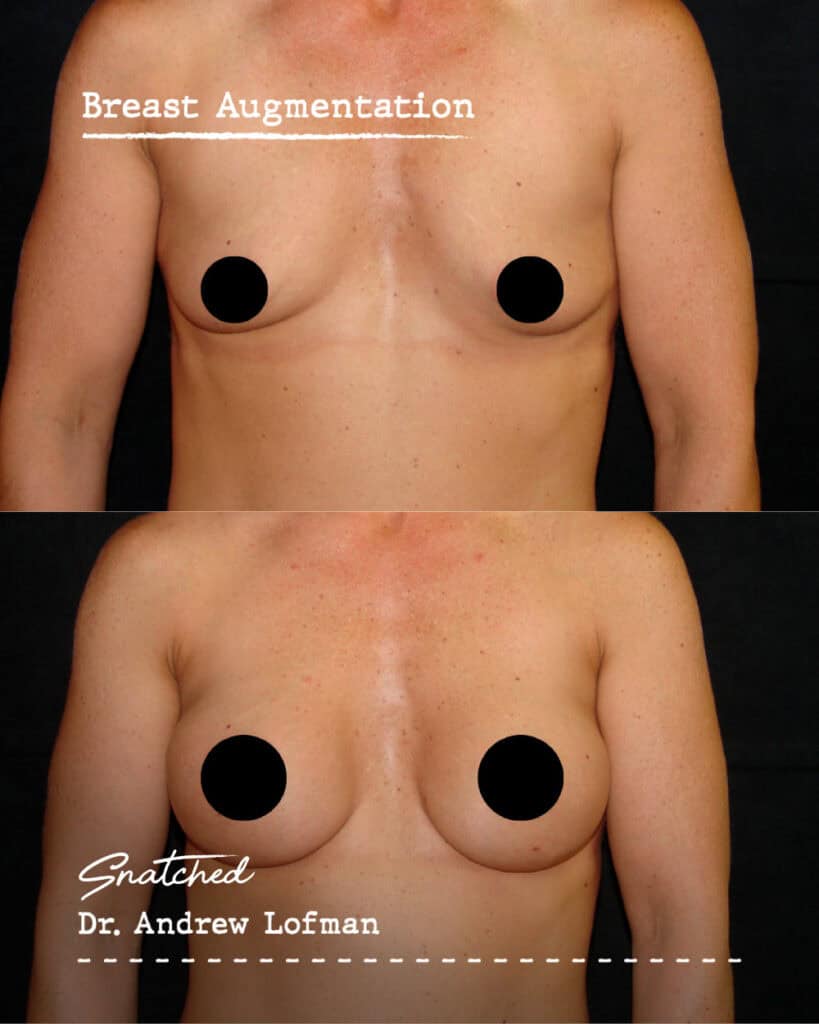 Before and after breast augmentation comparison