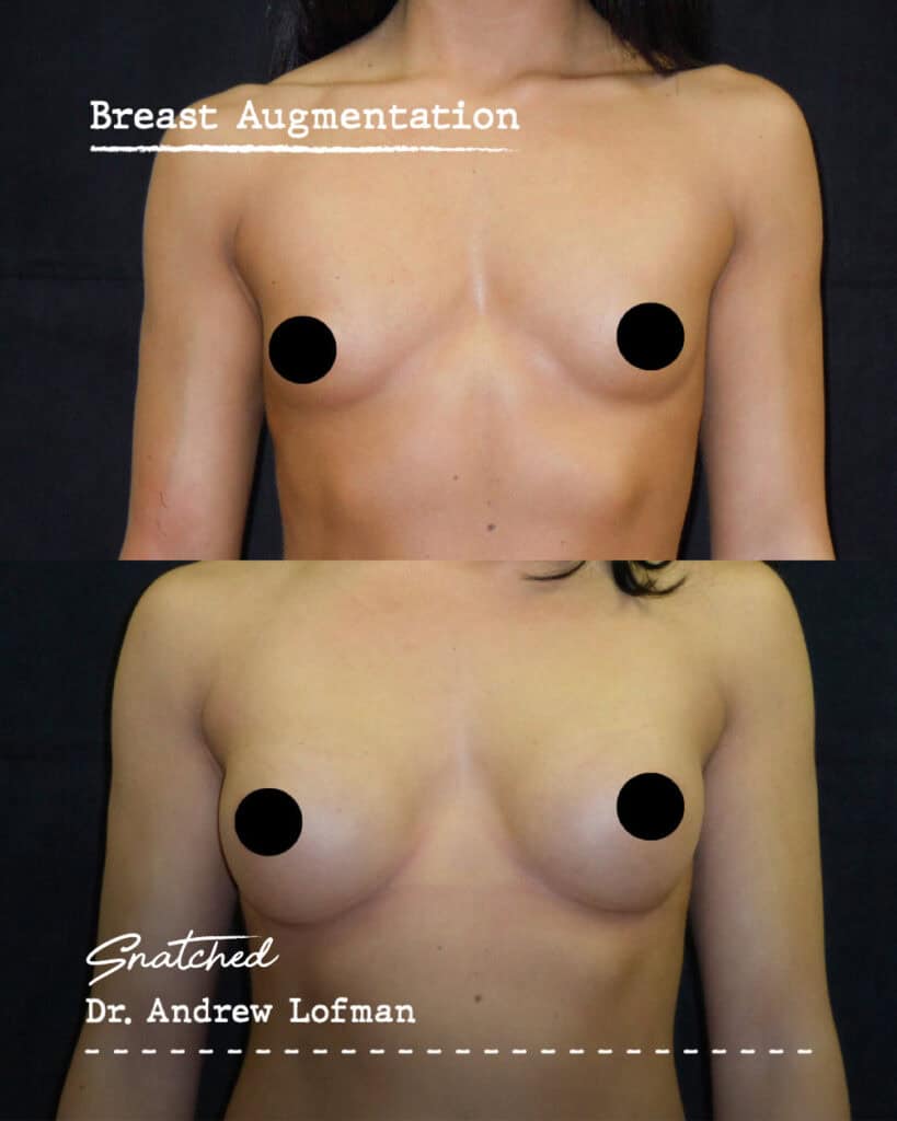 Before and after breast augmentation comparison.