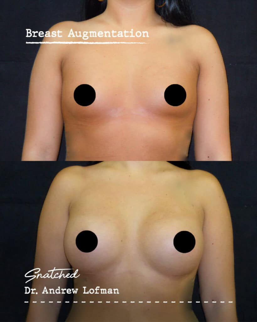 Before and after breast augmentation surgery.