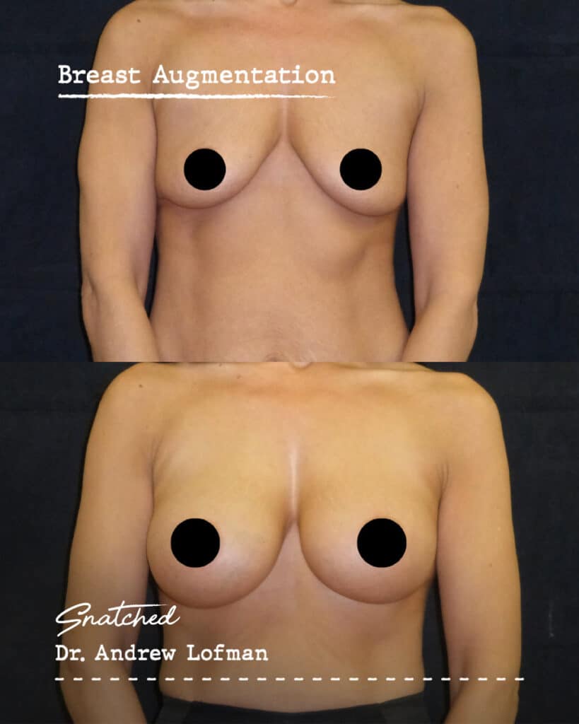 Before and after breast augmentation comparison.