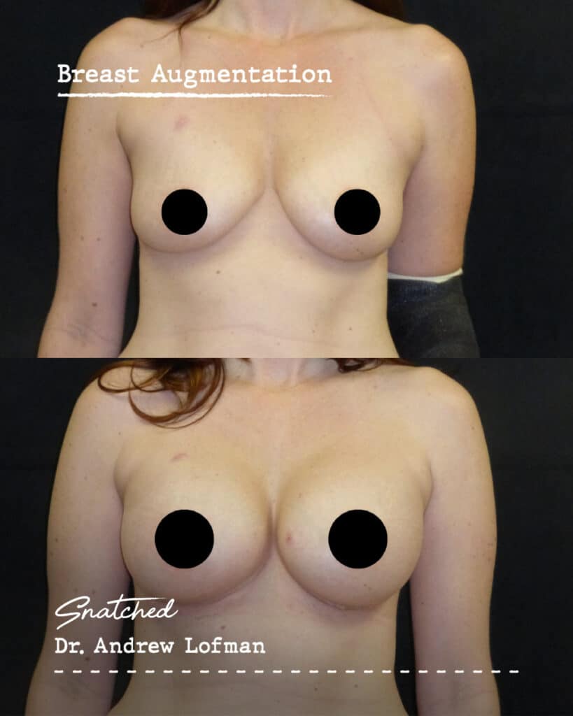 Before and after breast augmentation results