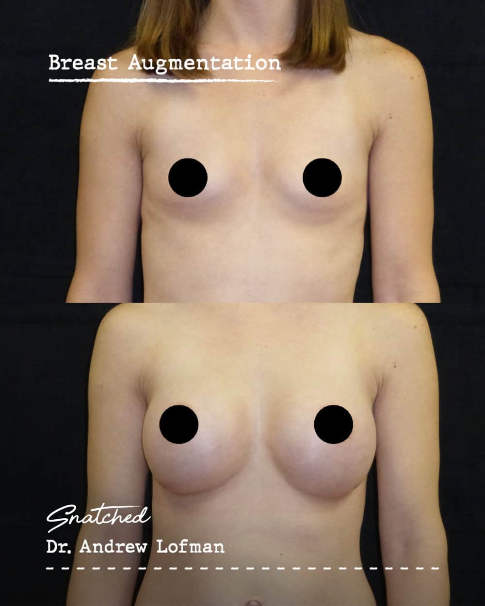 Before and after breast augmentation comparison.