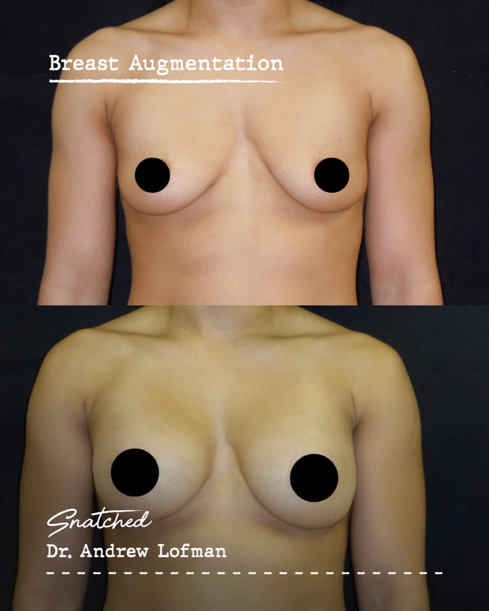 Before and after breast augmentation comparison photo.