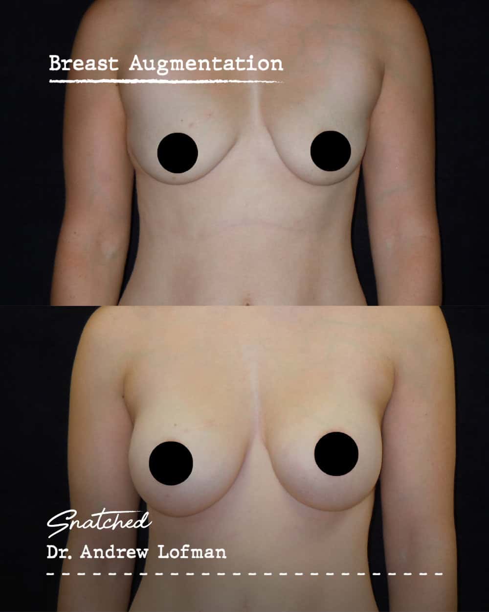 Breast augmentation before and after results photo.