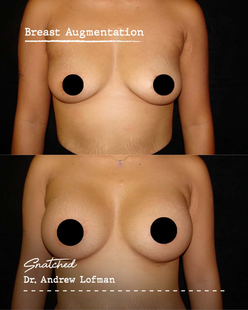 Before and after breast augmentation comparison.