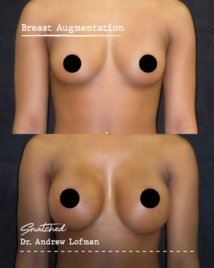 Before and after breast augmentation results