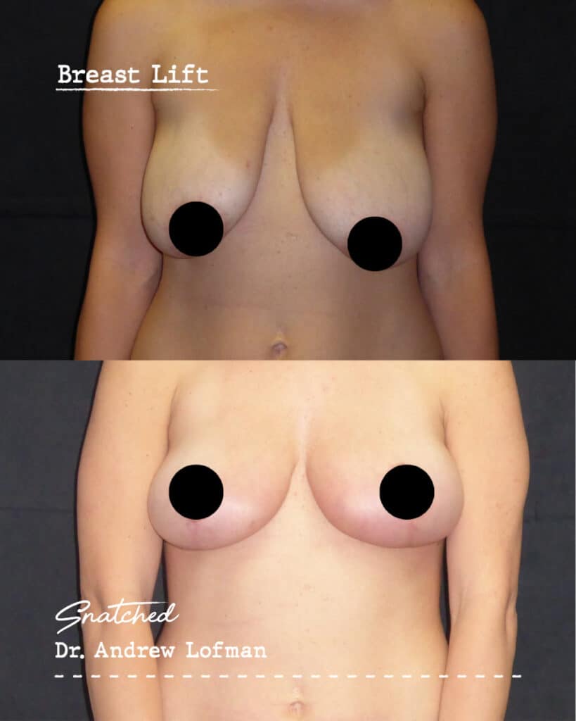 Breast lift before and after comparison