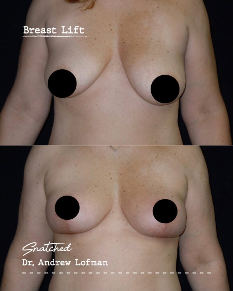 Before and after breast lift surgery comparison
