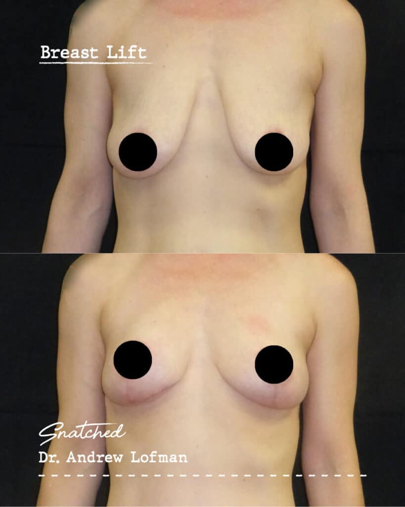 Breast lift before and after comparison.