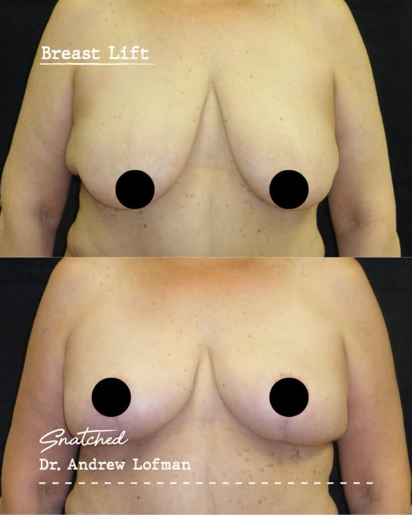 Before and after breast lift results