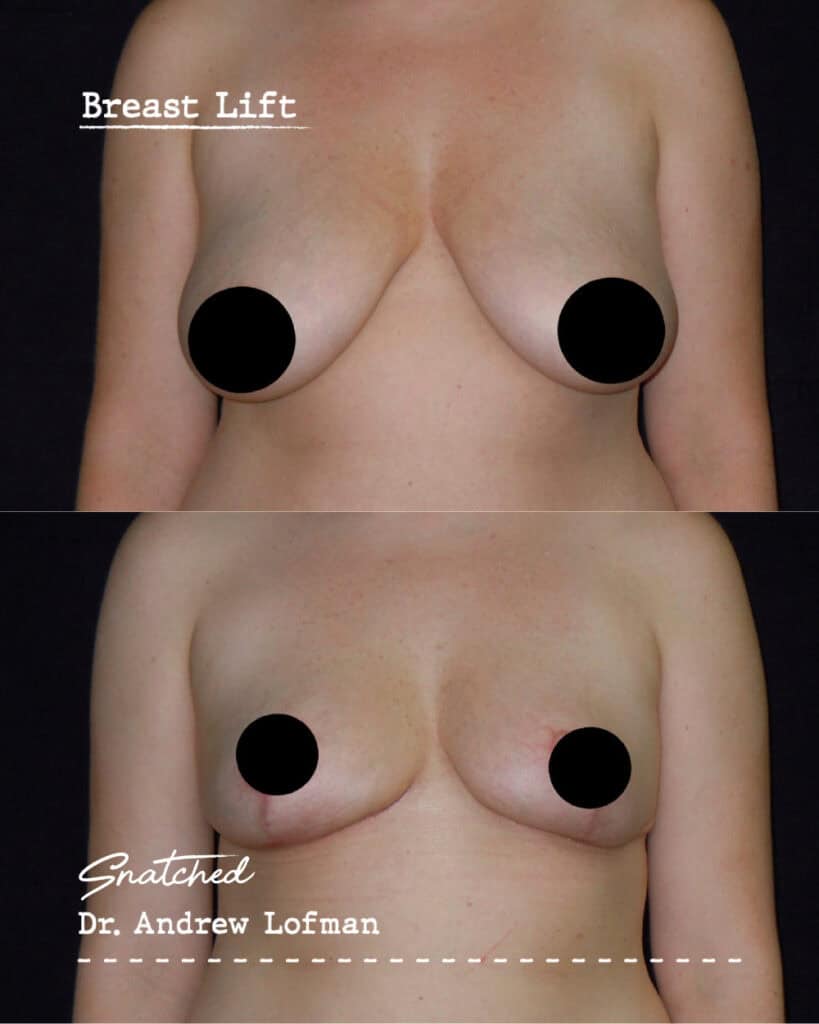 Breast lift before and after surgery comparison