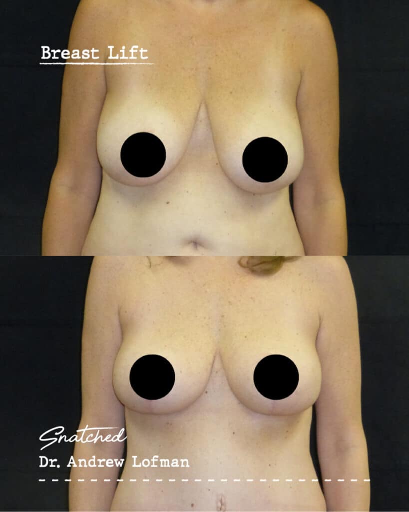 Before and after breast lift comparison.