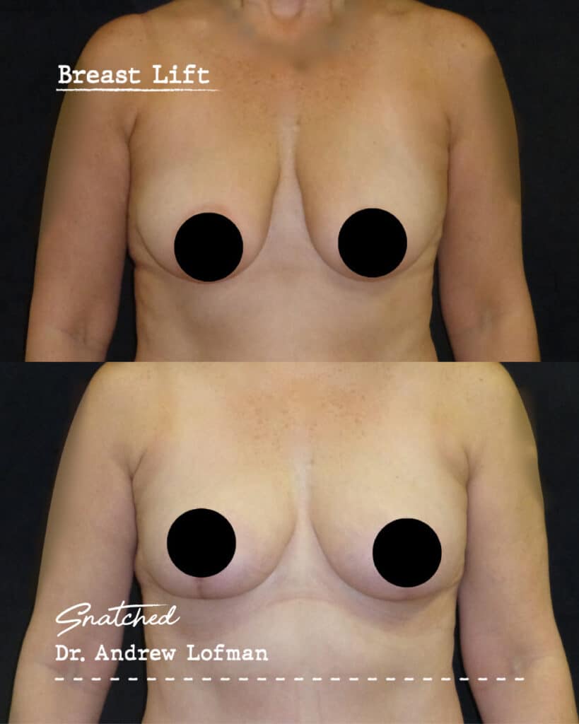 Before and after breast lift surgery results