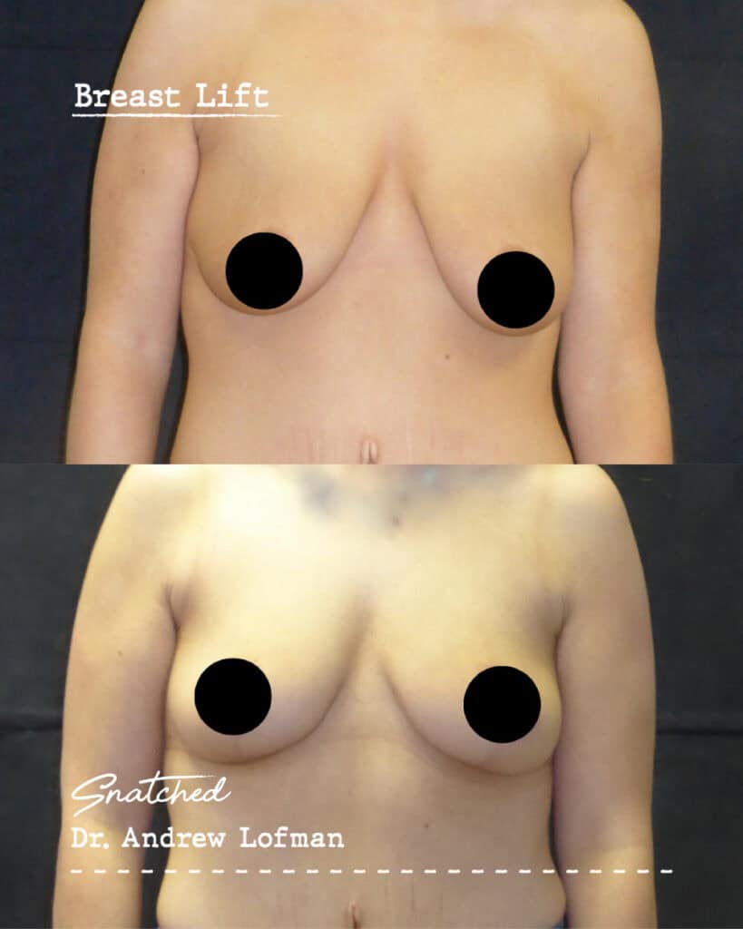 Before and after breast lift surgery results.