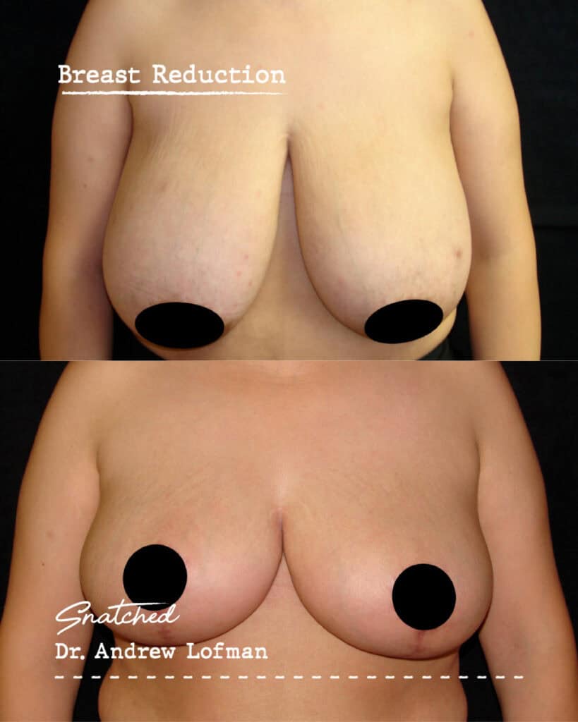 Before and after breast reduction surgery images.