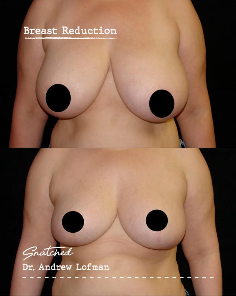 Before and after breast reduction surgery results.