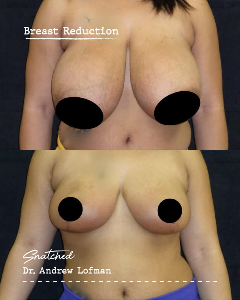 Breast reduction surgery before and after comparison