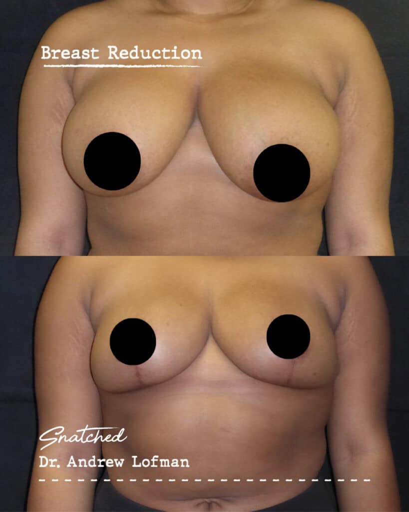Before and after breast reduction surgery results.