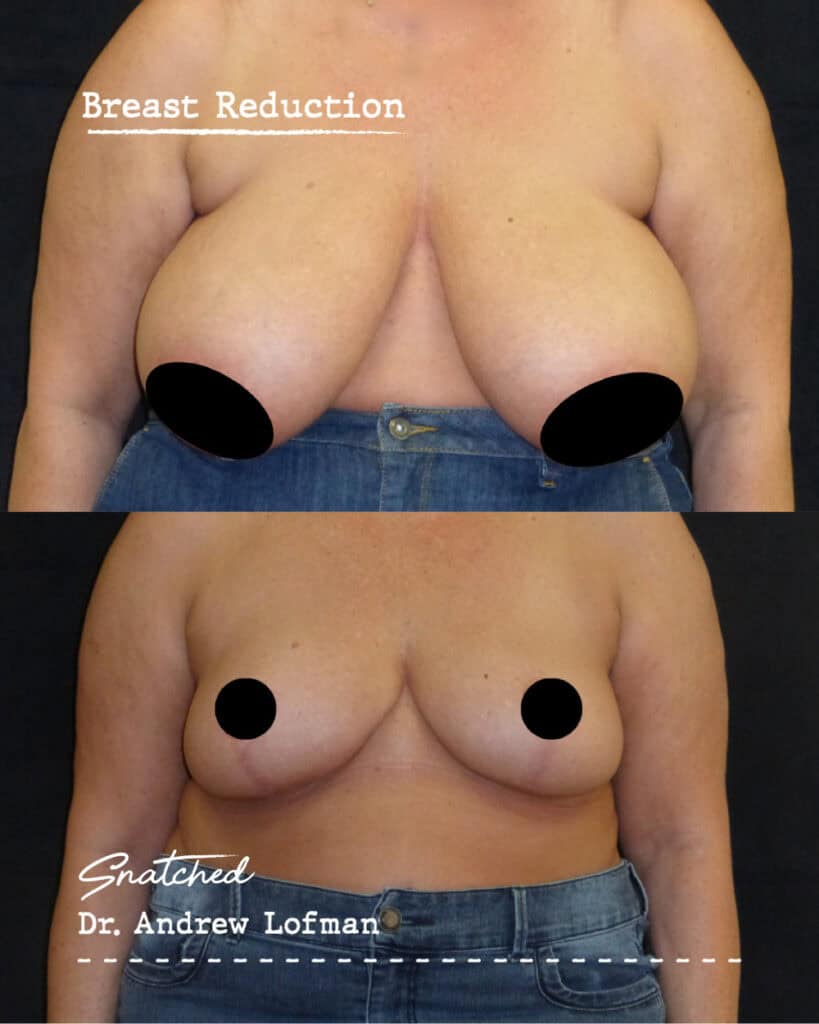 Breast reduction surgery before and after comparison.