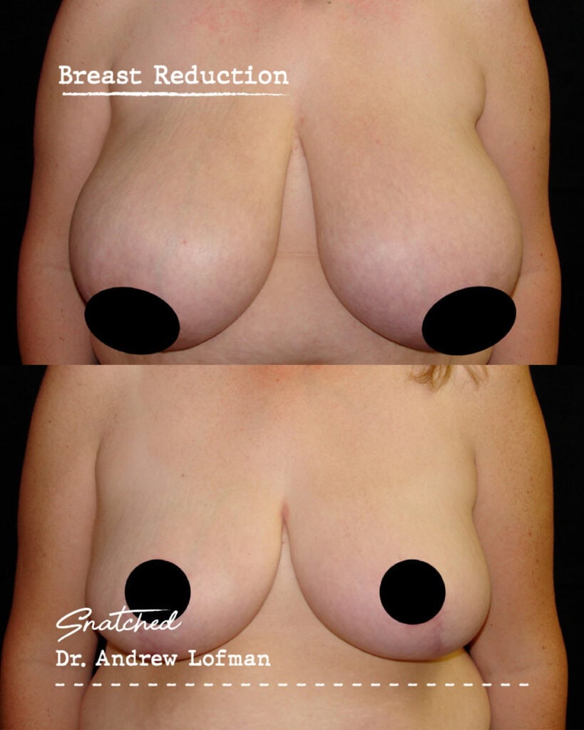 Breast reduction before and after results.
