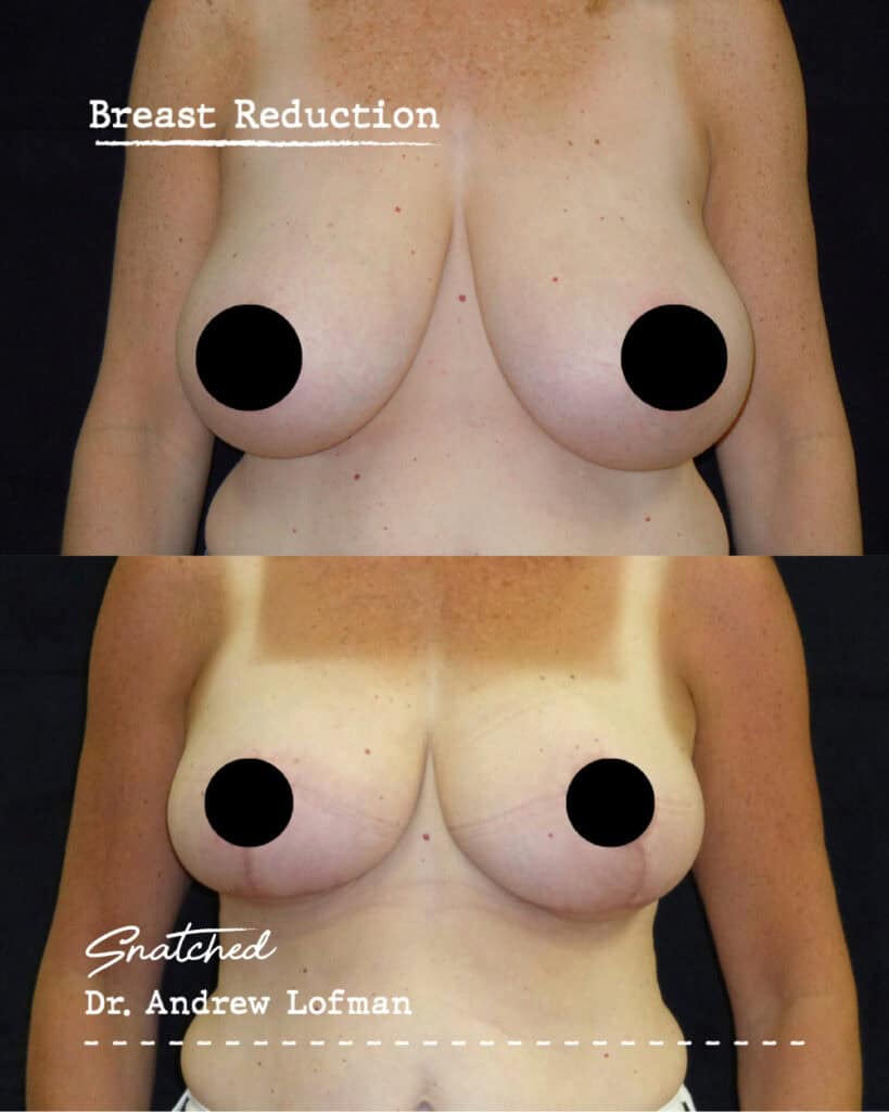 Before and after breast reduction surgery results.