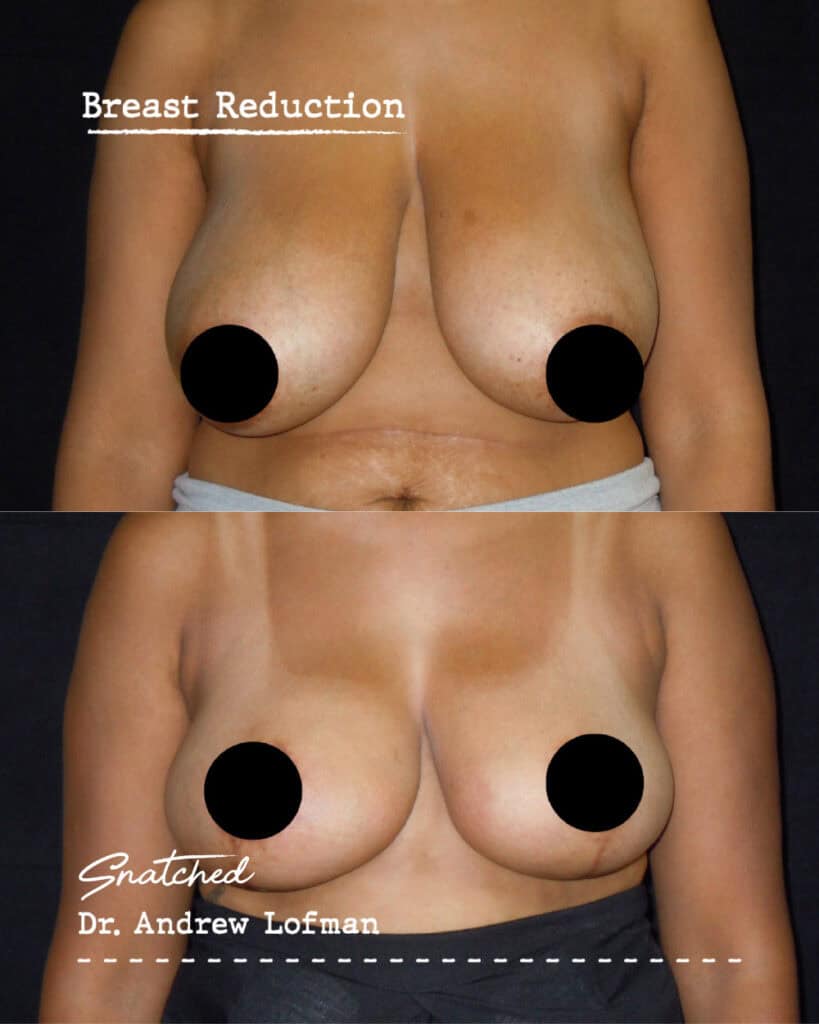 Before and after breast reduction surgery results