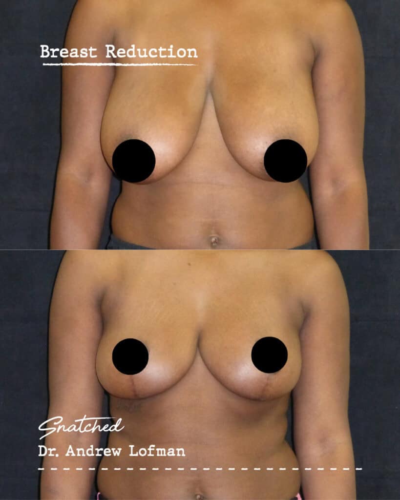 Before and after breast reduction surgery results.
