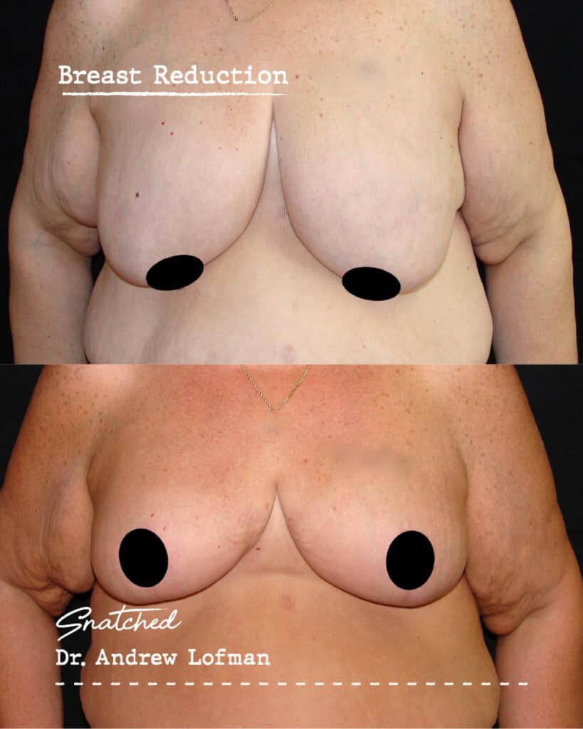 Breast reduction before and after photos.