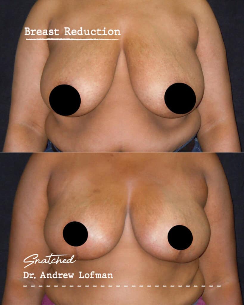 Before and after breast reduction surgery results