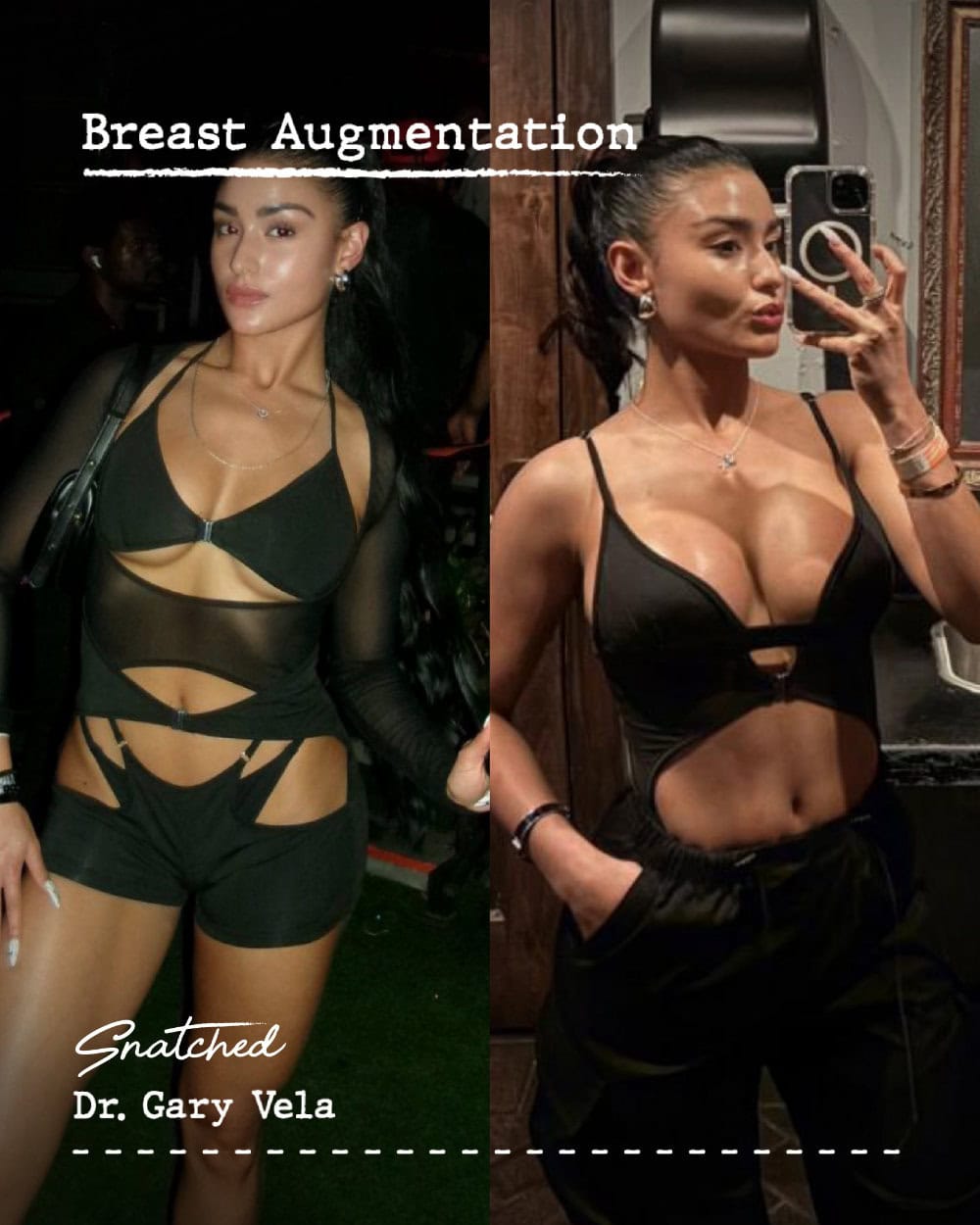 Before and after breast augmentation comparison
