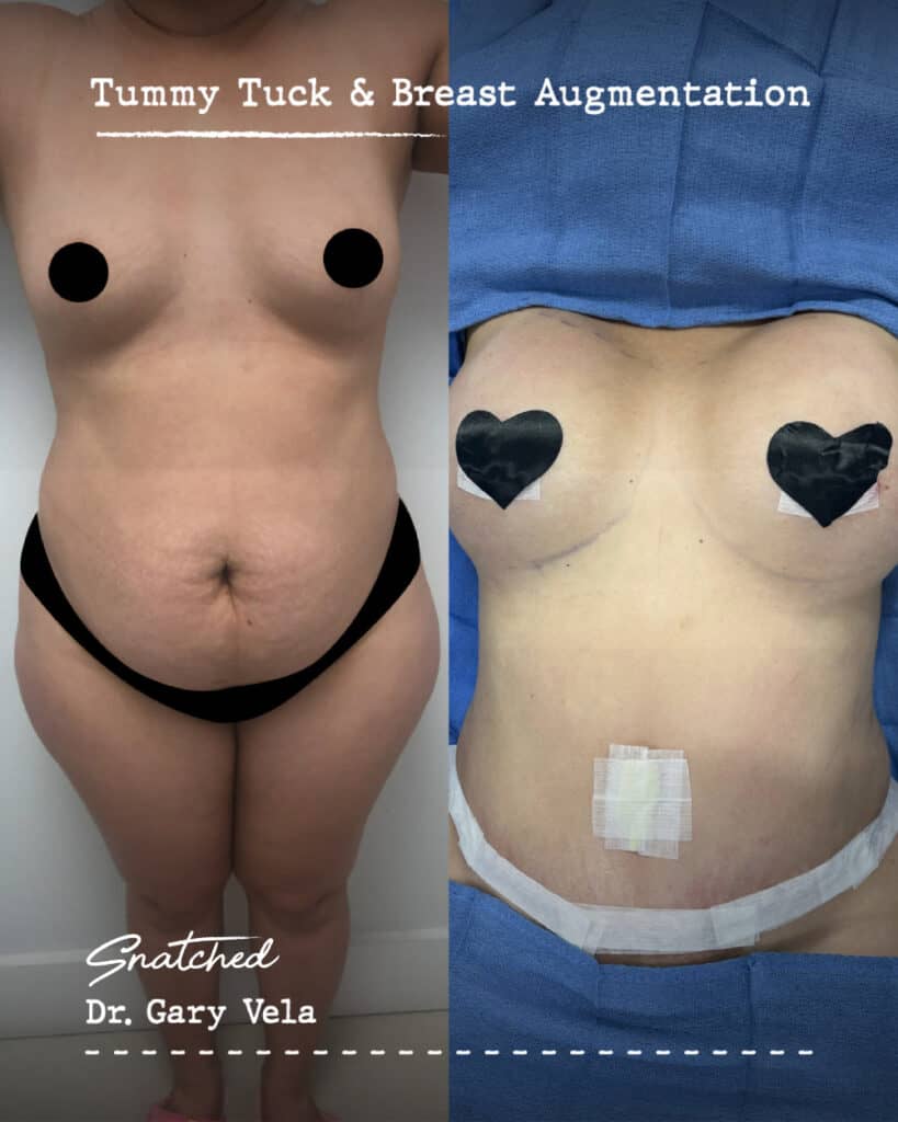 Woman's pre and post tummy tuck, breast surgery