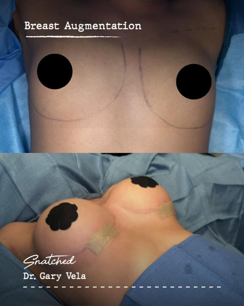 Before and after breast augmentation surgery