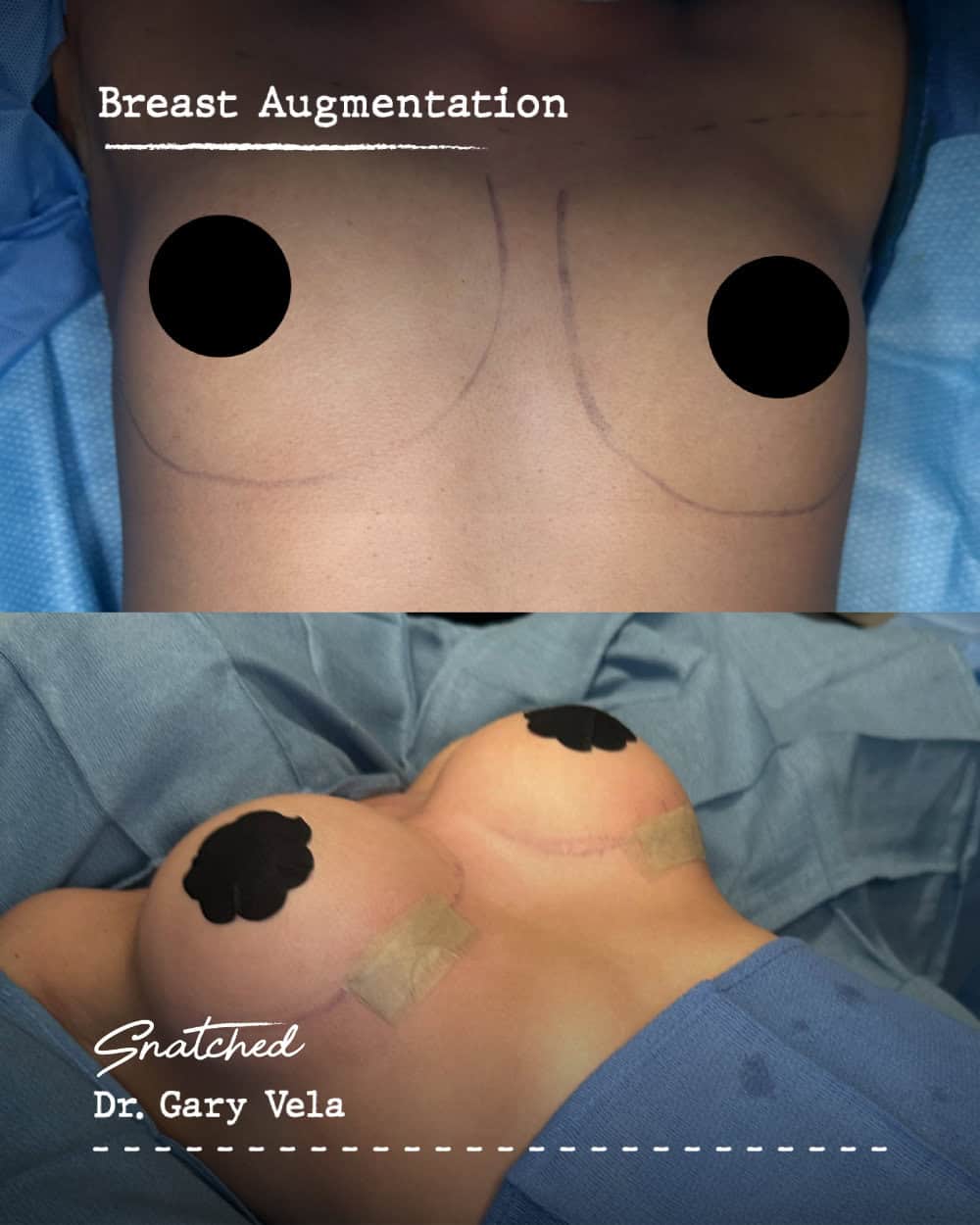 Before and after breast augmentation surgery
