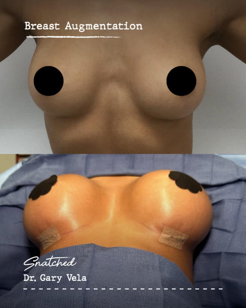Breast augmentation before and after comparison