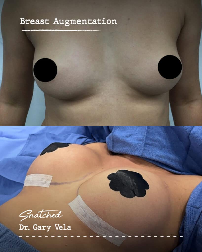 Breast augmentation before and after comparison