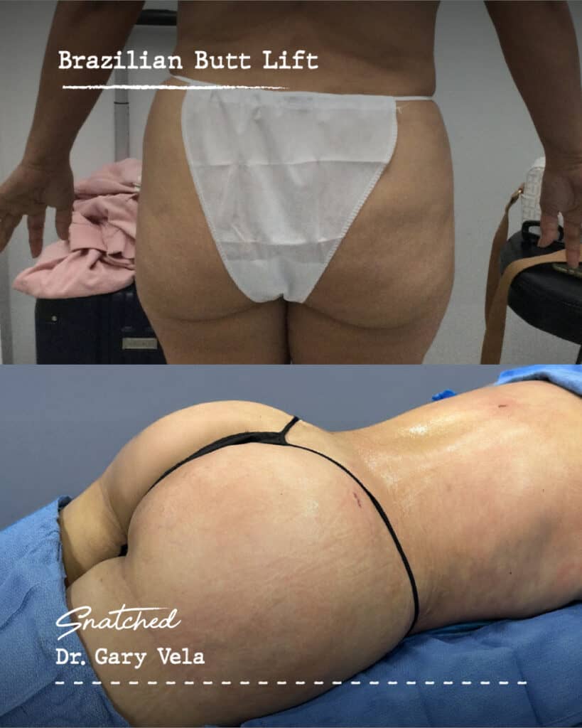 Brazilian Butt Lift before and after results